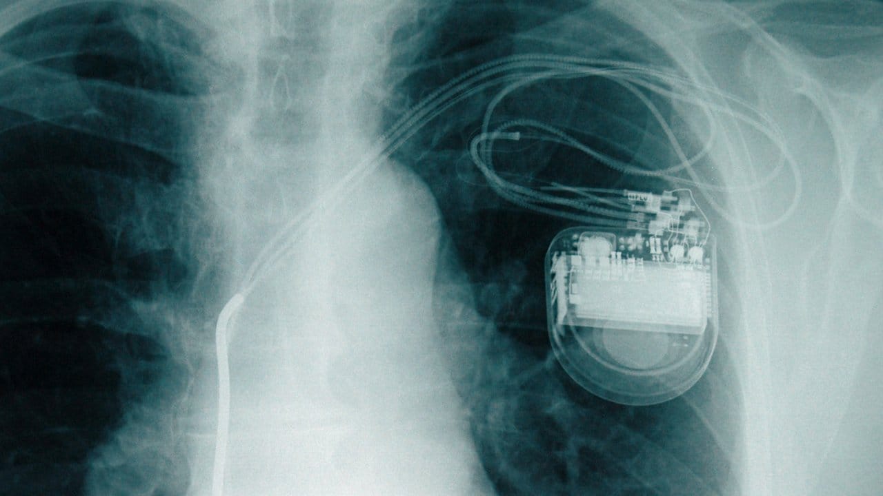 Lebensretter unter der Haut: Pro Jahr werden in Deutschland etwa 70.000 Herzschrittmacher implantiert.
