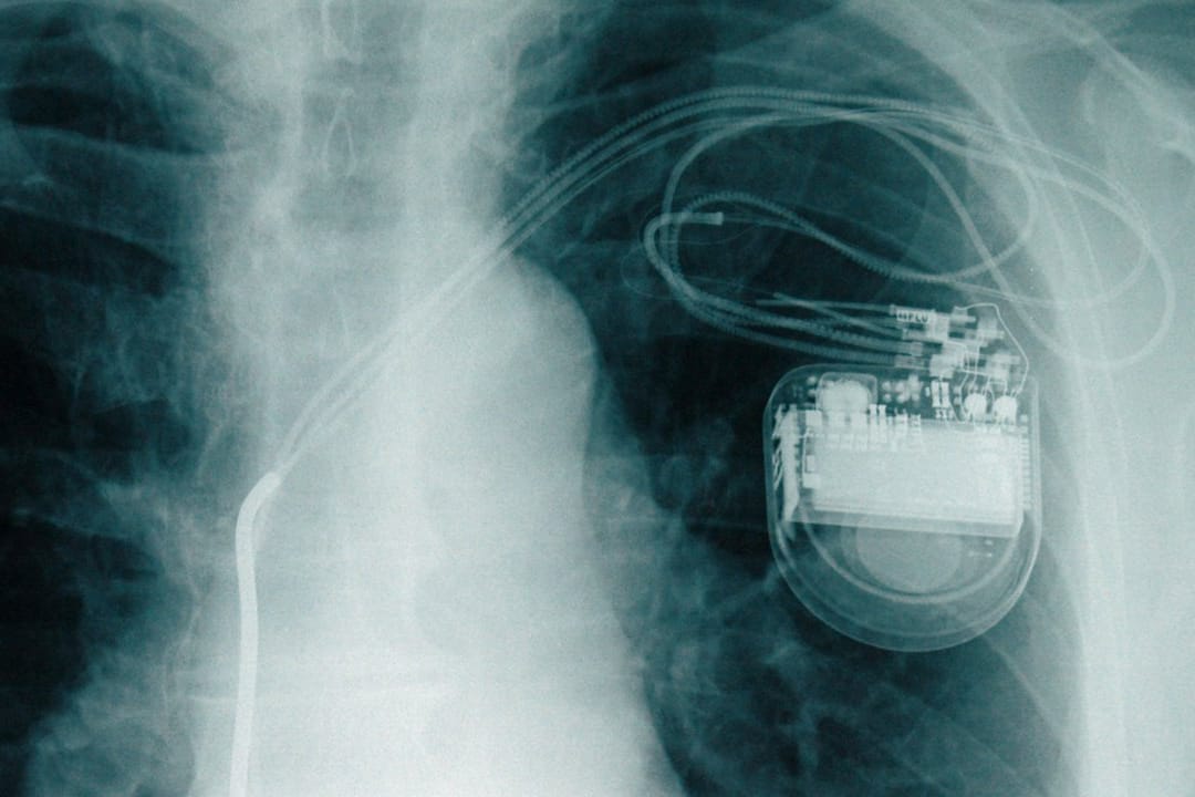Lebensretter unter der Haut: Pro Jahr werden in Deutschland etwa 70.000 Herzschrittmacher implantiert.