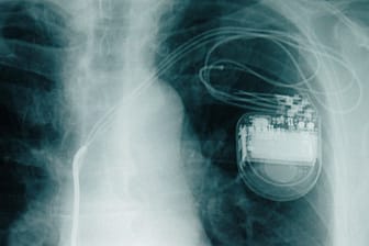 Lebensretter unter der Haut: Pro Jahr werden in Deutschland etwa 70.000 Herzschrittmacher implantiert.