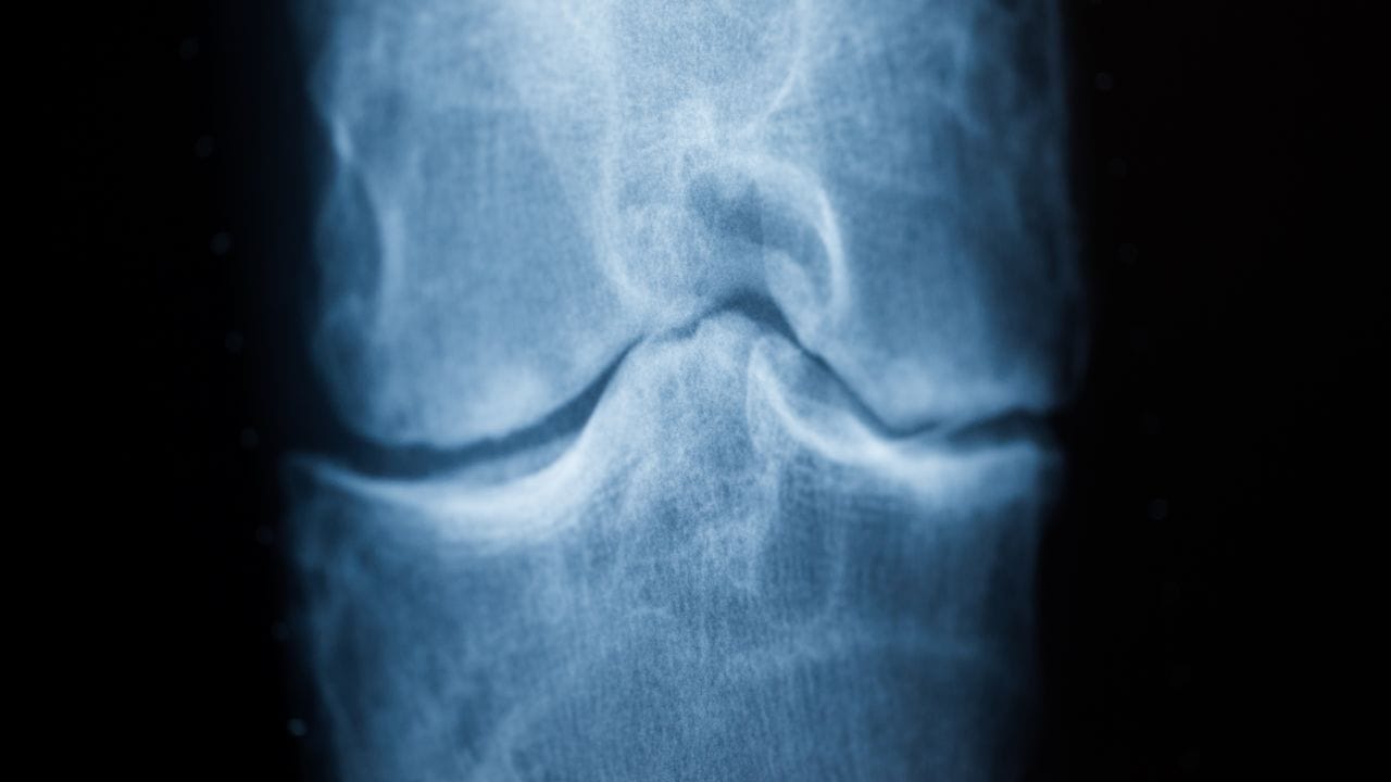 Wenn Knochen fast auf Knochen reibt: Im Verlauf einer Kniearthrose nutzt sich der Knorpel im Gelenk immer mehr ab.