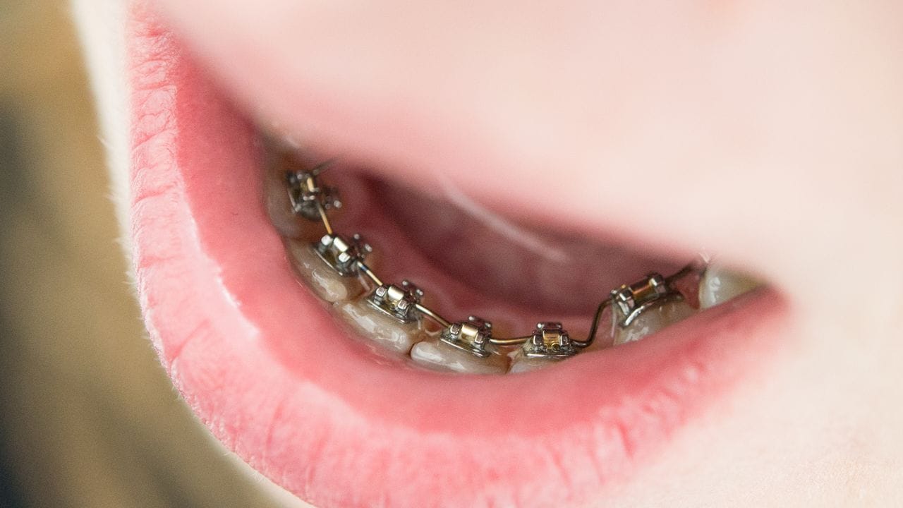 Gehört zur Grundausstattung von Teenagern: Die Zahnspange, die nicht auffallen soll.