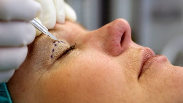 Eine Frau unterzieht sich einer Augenlidstraffung Eine Frau unterzieht sich einer Augenlidstraffung