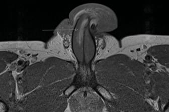 Vertikaler Penisbruch: Eine solche Aufnahme haben Mediziner in Großbritannien vor der Behandlung dieses Patienten noch nicht gesehen.