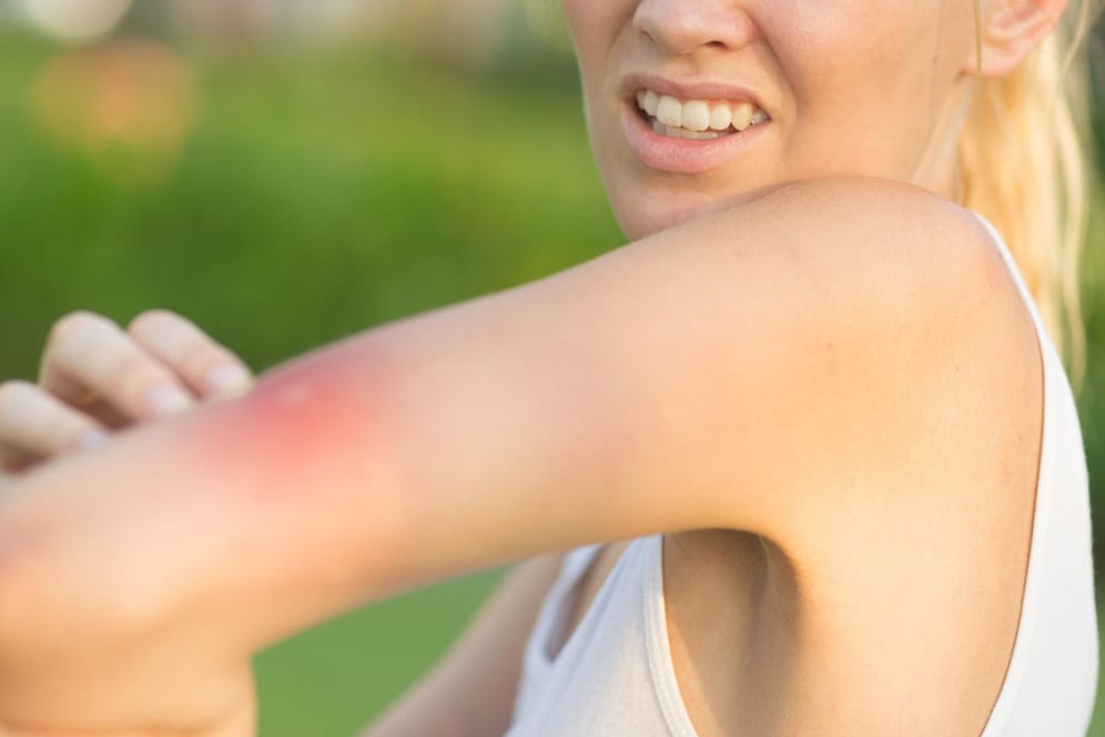 Schmerzen: Einige Insektenstiche oder -bisse spürt man erst lange nachdem das Insekt zugestochen hat.