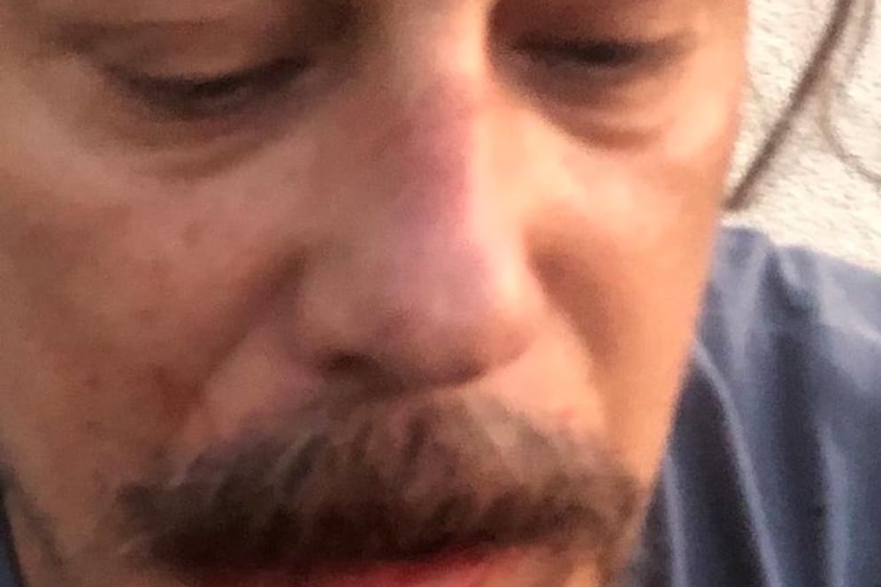 Der Journalist Erk Acarer: Er teilte ein Foto von sich und berichtete von einem Angriff.