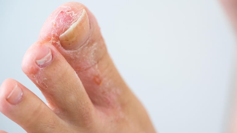 Fußpilz: Rötungen, Hautrisse und schuppende Stellen sind häufige Symptome einer Tinea pedis.
