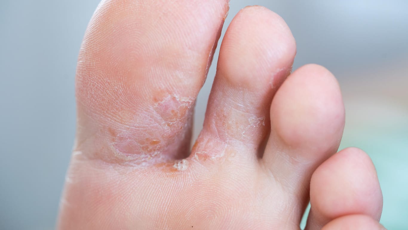 Fußpilz: Typische Symptome sind schuppende, gerötete Stellen zwischen den Zehen.