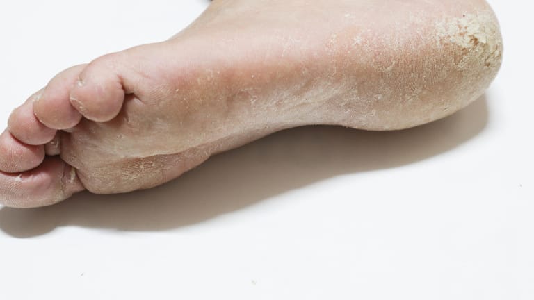 Fußpilz: Tinea pedis kann unter der Fußsohle entstehen.
