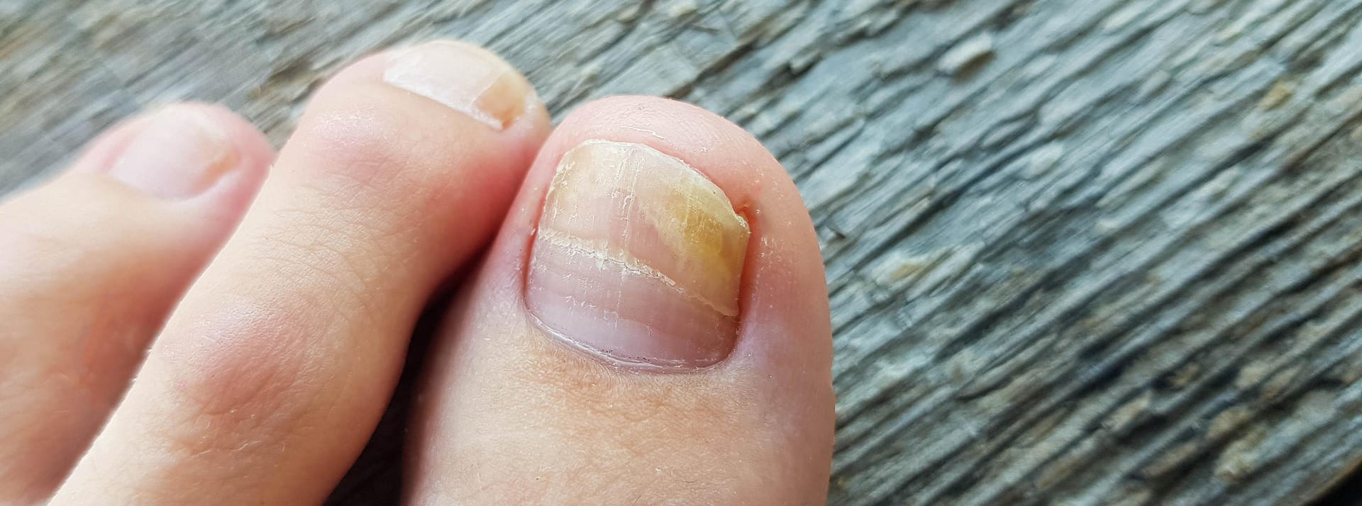 Nagelveränderungen durch Nagelpilz: Fußpilz kann auf die Nägel übergehen.
