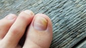 Nagelveränderungen durch Nagelpilz: Fußpilz kann auf die Nägel übergehen.