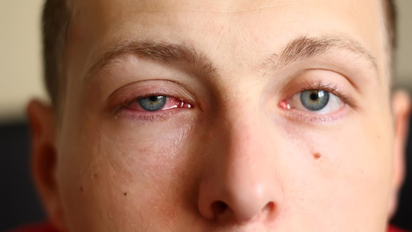 Mann mit Bindehautentzündung: Eine Konjunktivitis tritt häufig im Rahmen einer Allergie auf.