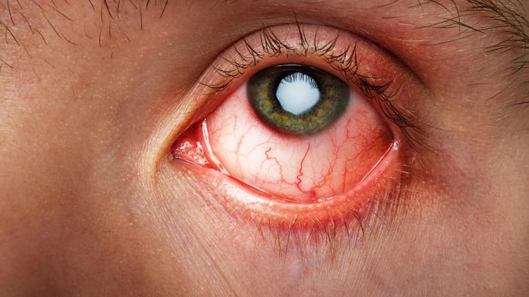 Bindehautentzündung: Das Auge ist gerötet, kann jucken und brennen.