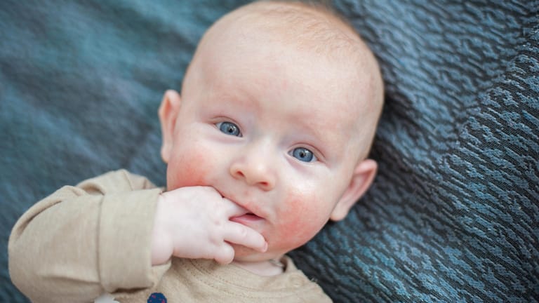 Ekzeme auf den Wangen: Bei Babys beginnt Neurodermitis oft im Gesicht.