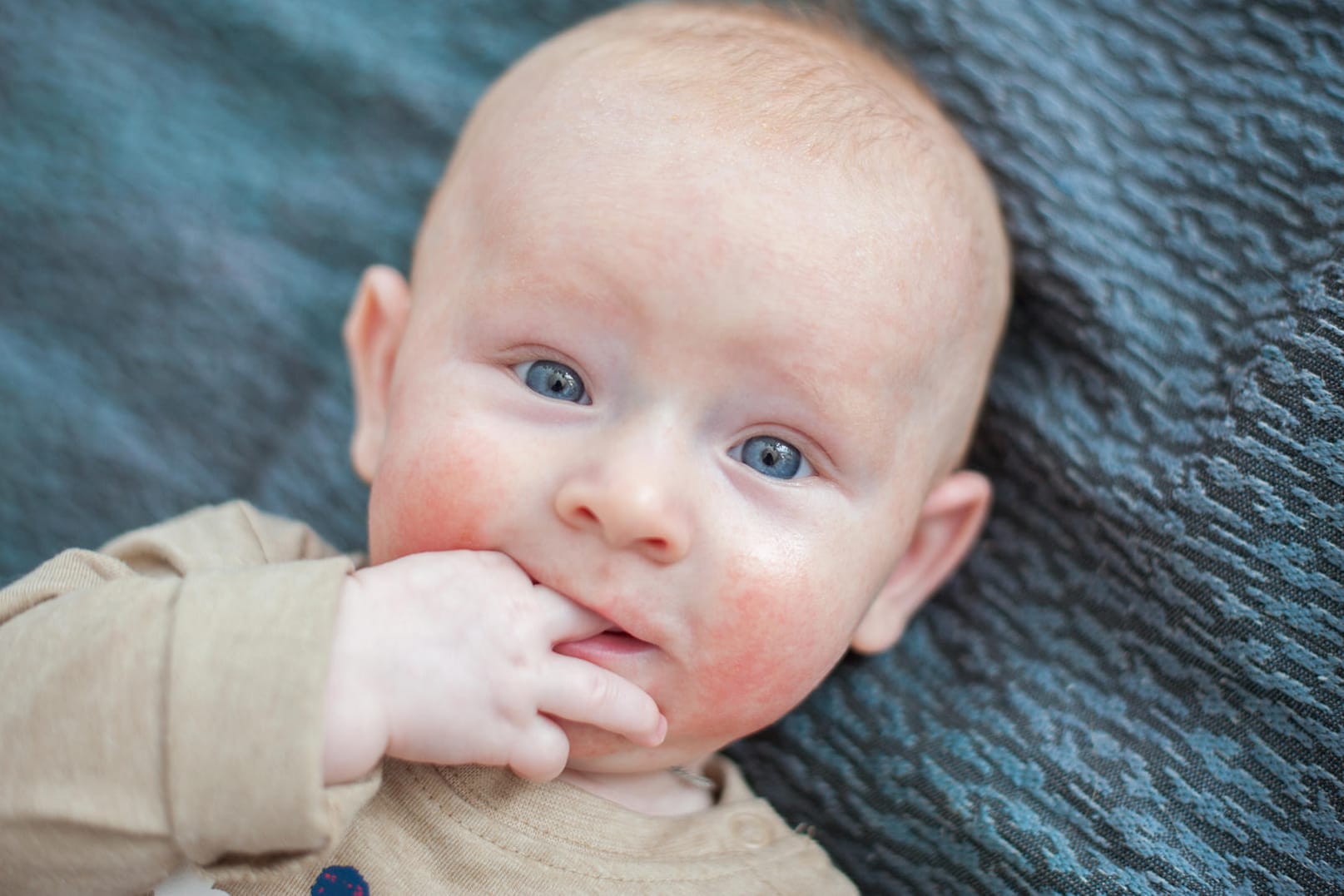 Ekzeme auf den Wangen: Bei Babys beginnt Neurodermitis oft im Gesicht.