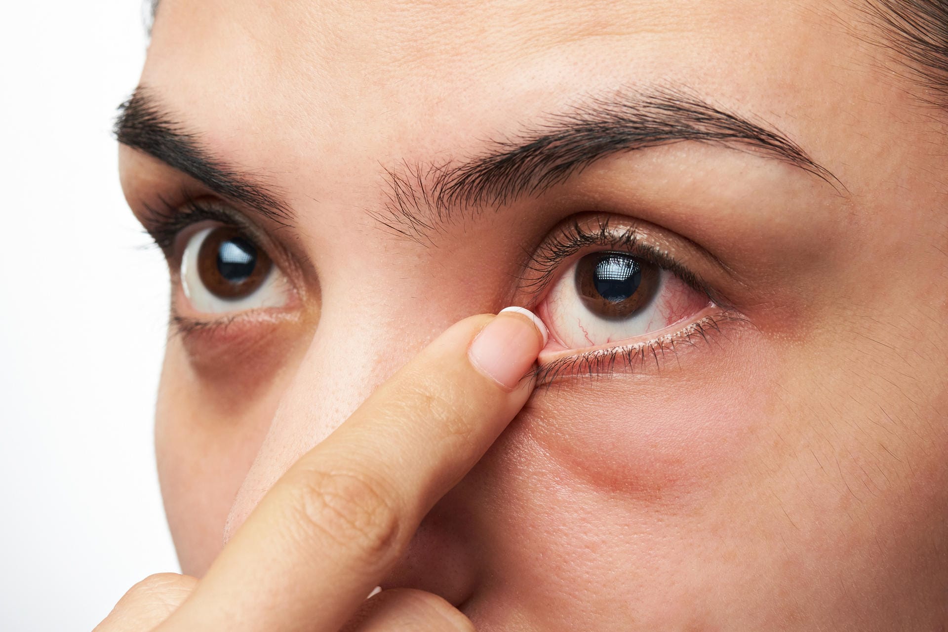 Eine Frau fasst sich an ihr gerötetes Auge. Trockene Augen sind eine Volkskrankheit. Sie sind häufig die Folge von intensiver Bildschirmarbeit in Innenräumen.