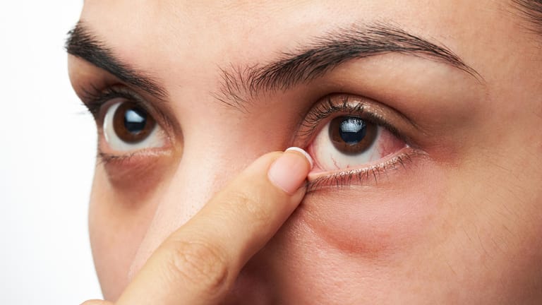 Eine Frau fasst sich an ihr gerötetes Auge. Trockene Augen sind eine Volkskrankheit. Sie sind häufig die Folge von intensiver Bildschirmarbeit in Innenräumen.
