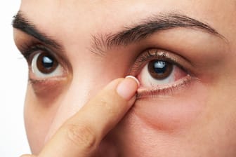 Eine Frau fasst sich an ihr gerötetes Auge. Trockene Augen sind eine Volkskrankheit. Sie sind häufig die Folge von intensiver Bildschirmarbeit in Innenräumen.