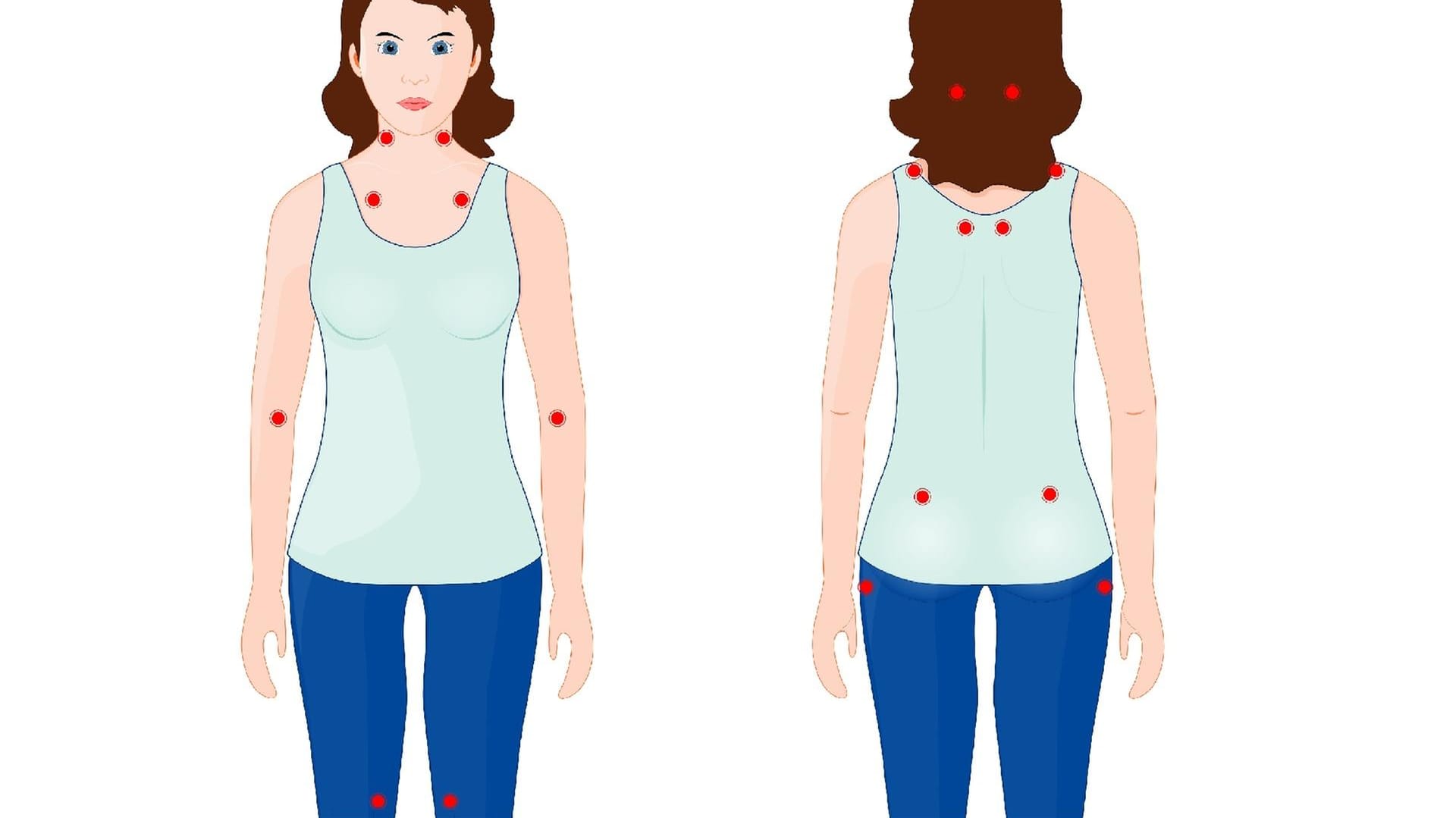 Darstellung der 18 Tenderpoints bei Fibromyalgie: Druck kann dort Schmerz auslösen.