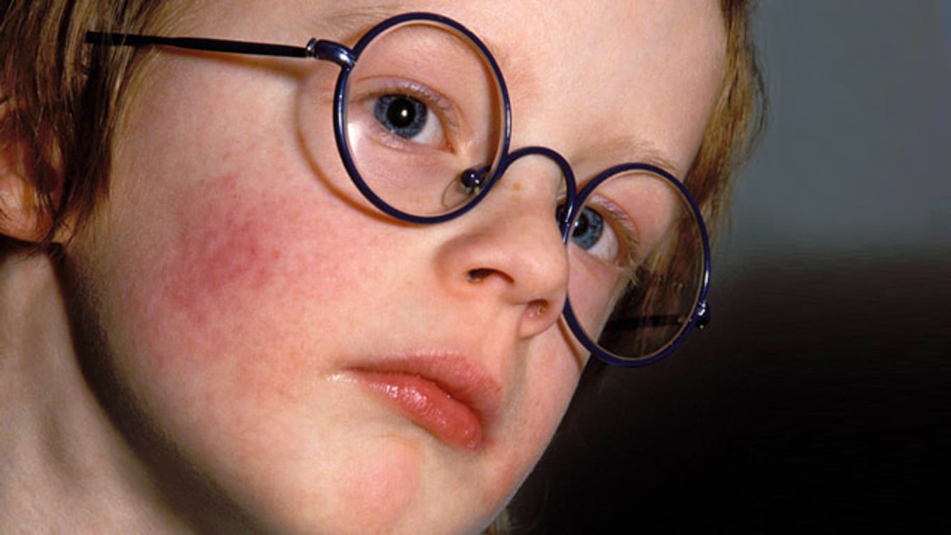 Kinderkrankheiten: Ringelröteln zeigen sich einige Tage nach der Ansteckung mit Ausschlag im Gesicht und an Armen und Beinen.