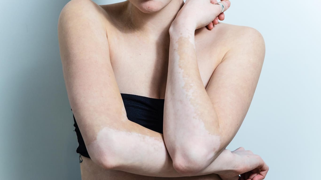 Pigmentstörung auf der Haut: Vitiligo tritt oft zusammen mit anderen Autoimmunerkrankungen auf.