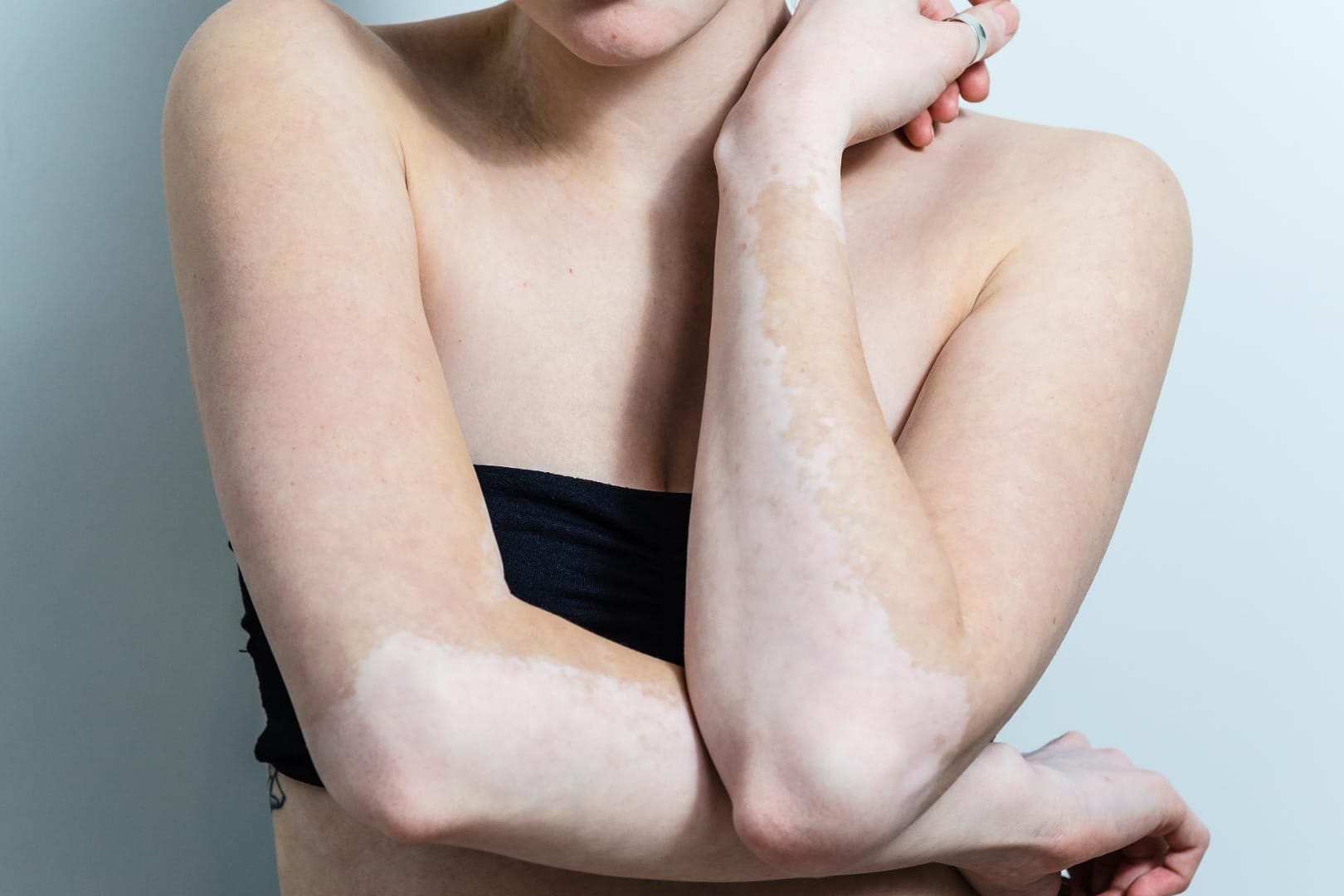 Pigmentstörung auf der Haut: Vitiligo tritt oft zusammen mit anderen Autoimmunerkrankungen auf.