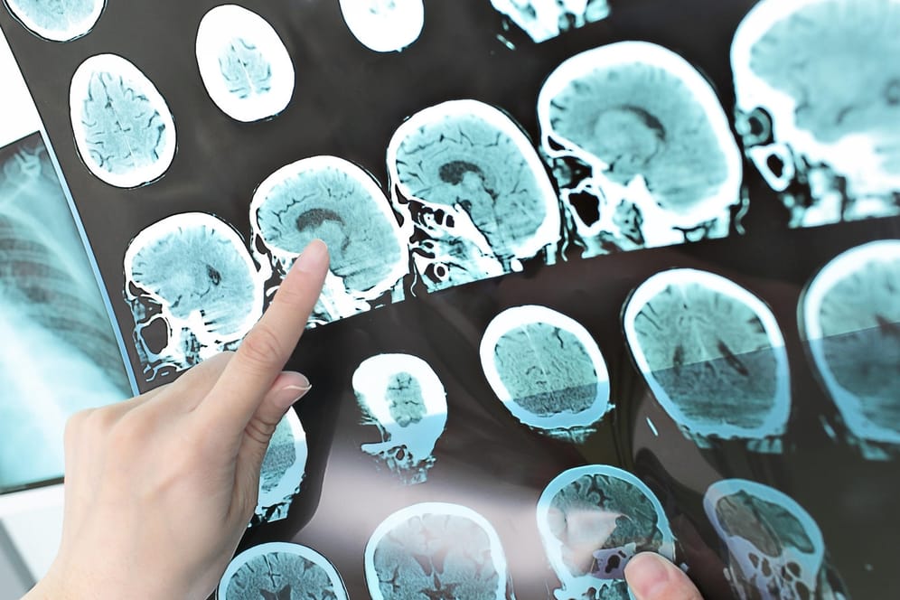 MRT-Bild einer Multiplen Sklerose im Gehirn
