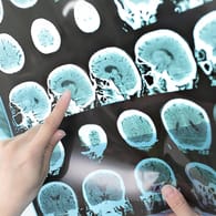 MRT-Bild einer Multiplen Sklerose im Gehirn