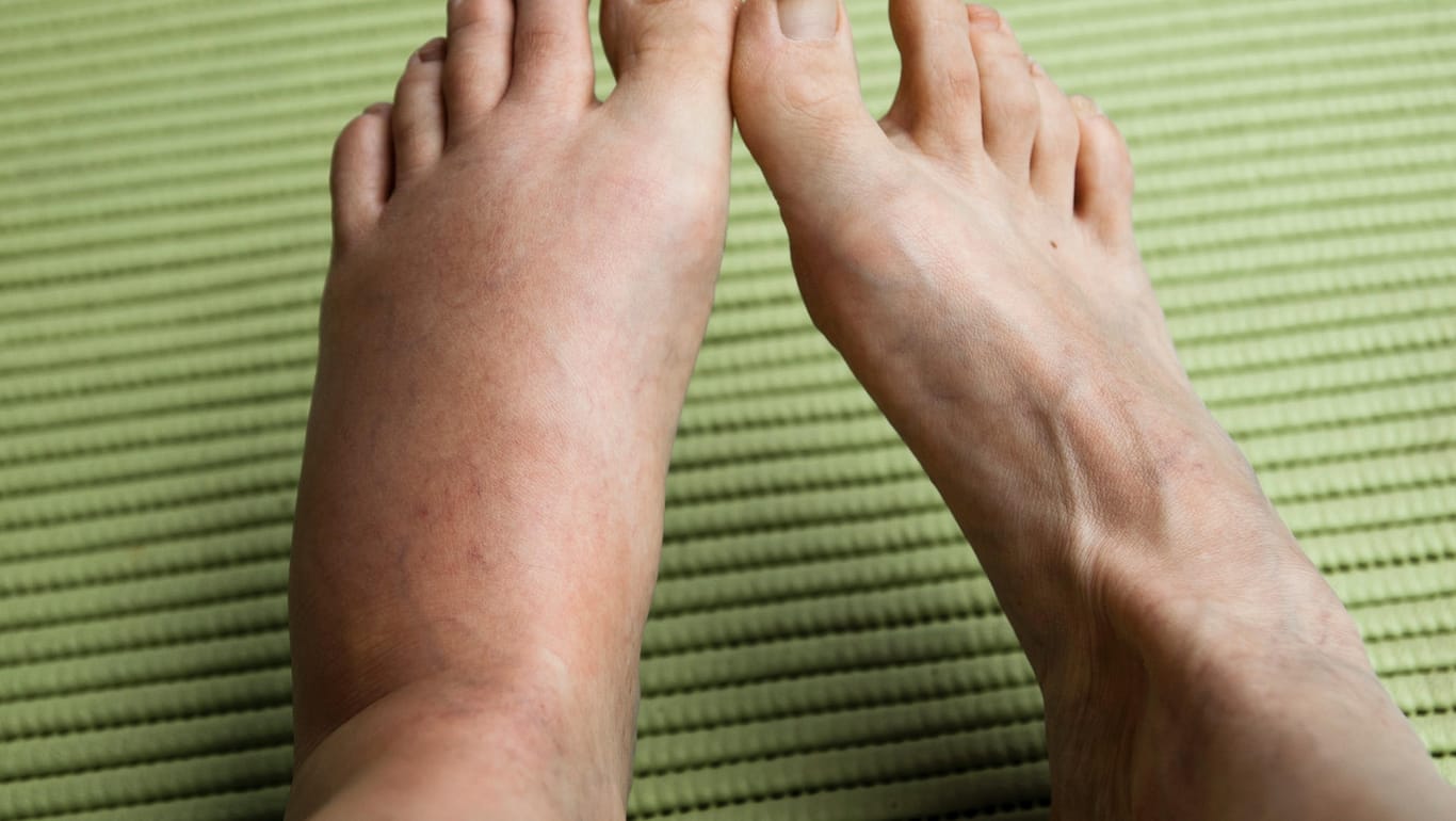 Geschwollener Fuß: Gehen Sie bei heftigen Reaktionen auf einen Insektenstich zum Arzt.
