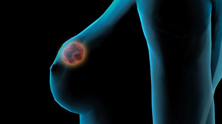 Knoten in der Brust: Nicht immer handelt es sich um einen Tumor.