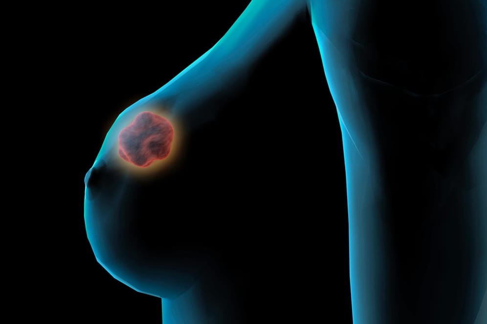 Knoten in der Brust: Nicht immer handelt es sich um einen Tumor.