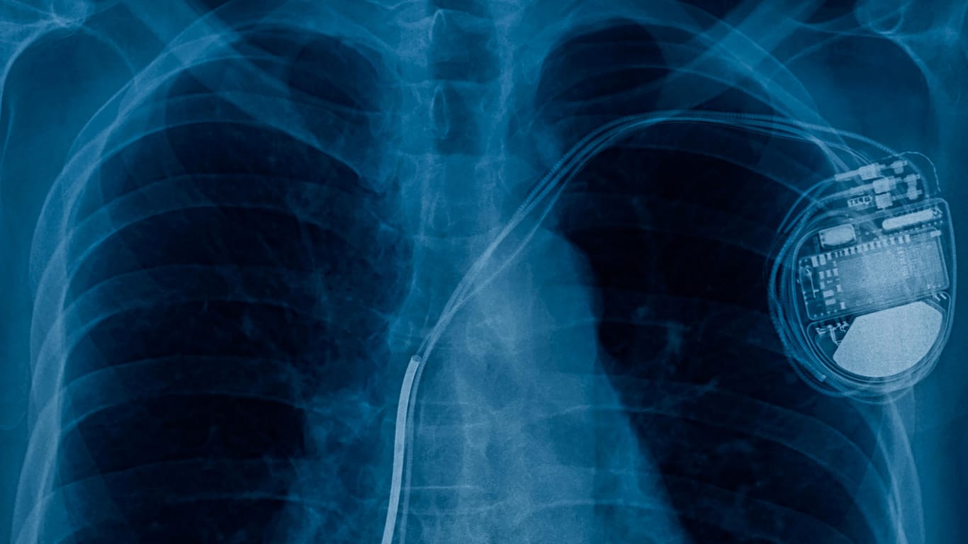 Herz-Mythos: Kann man mit einem Herzschrittmacher überhaupt sterben?