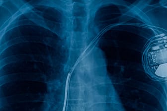 Herz-Mythos: Kann man mit einem Herzschrittmacher überhaupt sterben?