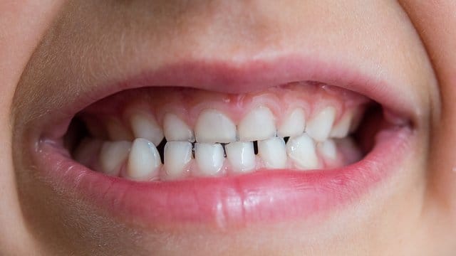 Für eine kieferorthopädische Behandlung bei Kindern und Jugendlichen geben meist ästhetische den Ausschlag. Für eine kieferorthopädische Behandlung bei Kindern und Jugendlichen geben meist ästhetische den Ausschlag.