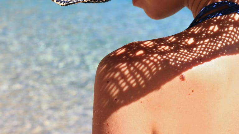 Hautkrebsrisiko: Wenn Sie viele Leberflecken haben, sollten Sie sich vor allem bei starker Sonneneinstrahlung schützen.