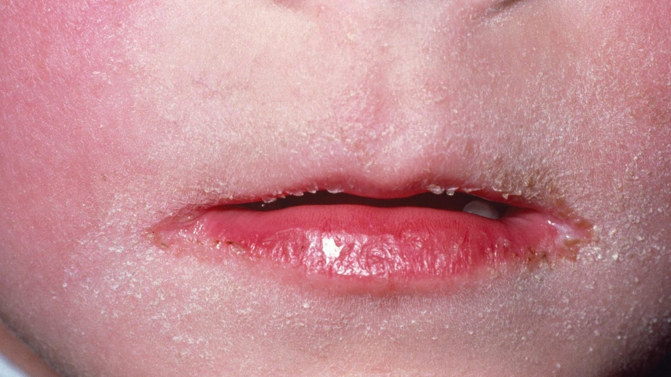 Gesicht von einem Kind mit Scharlach: Typischerweise bleibt der Bereich um den Mund herum blass, während der Rest des Gesichts gerötet ist.