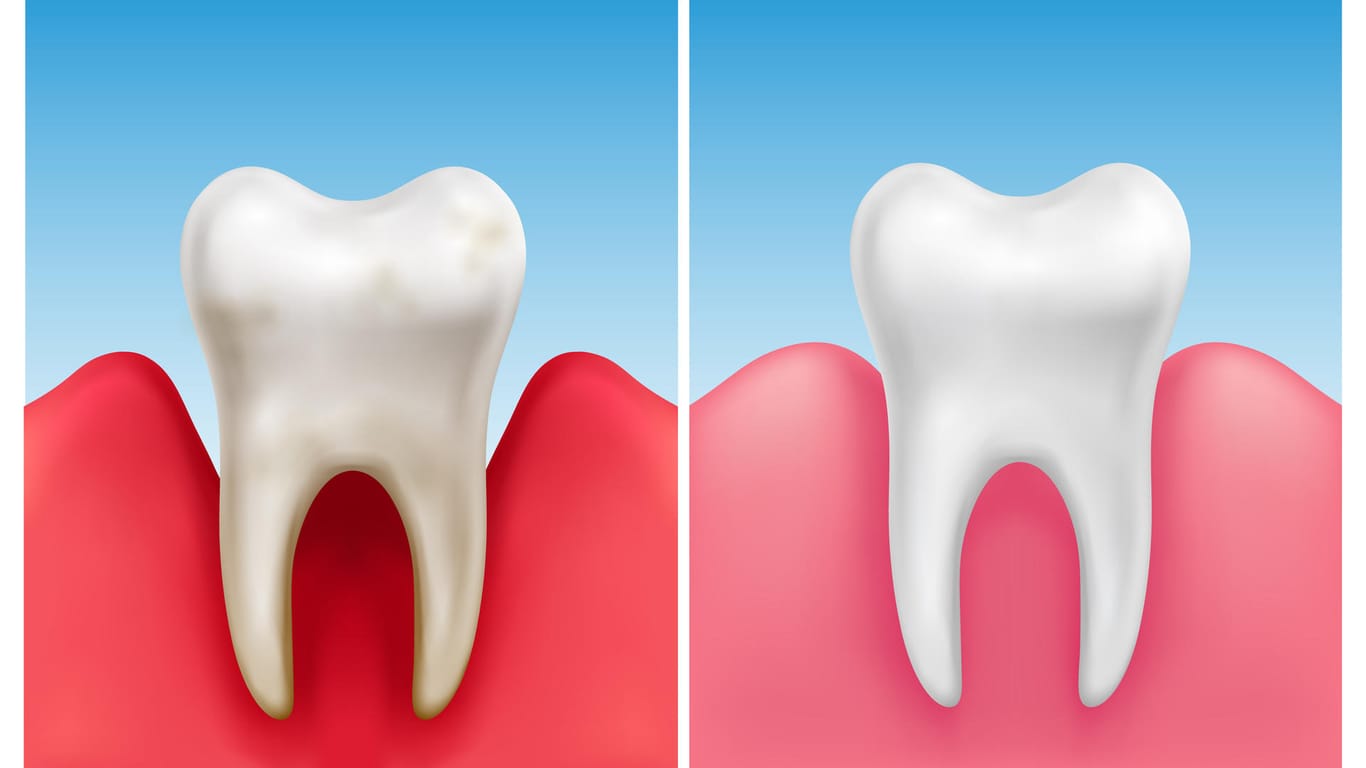 Illustration von entzündetem Zahnfleisch (links) und gesundem Zahnfleisch (rechts) im Vergleich.