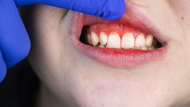Zahnfleischbluten: Wer schnell Zahnfleischbluten bekommt, sollte dies unbedingt ernst nehmen und zum Zahnarzt gehen.