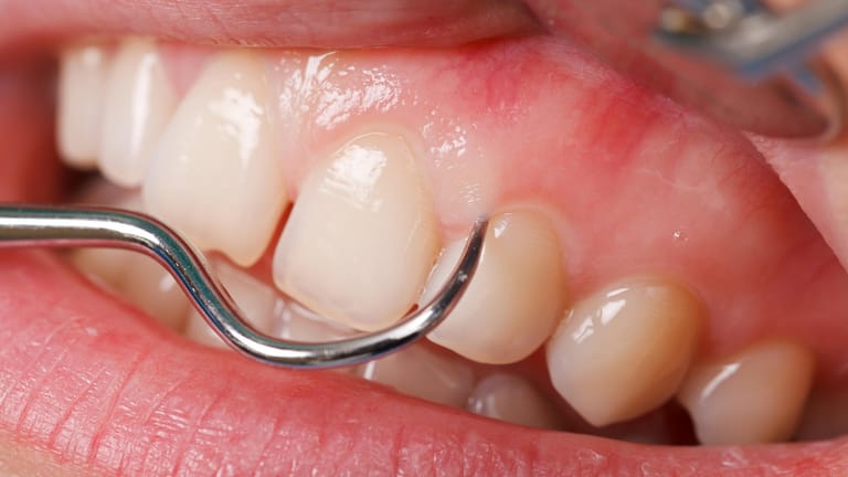 Zahnfleisch: Gesundes Zahnfleisch ist rosa und fest.