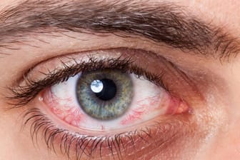 Auge: Die Augenerkrankung Grüner Star ist unheilbar und kann zur Erblindung führen. (Symbolbild)