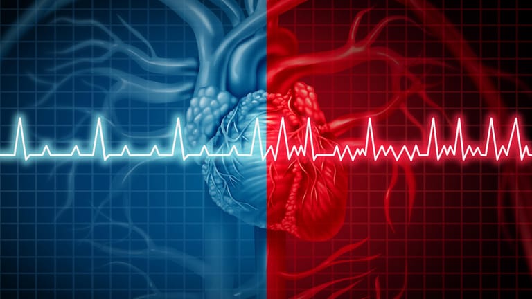 Herzrhythmusstörungen im EKG: Vorhofflimmern kann ein Blutgerinnsel auslösen und zu einem Schlaganfall führen.