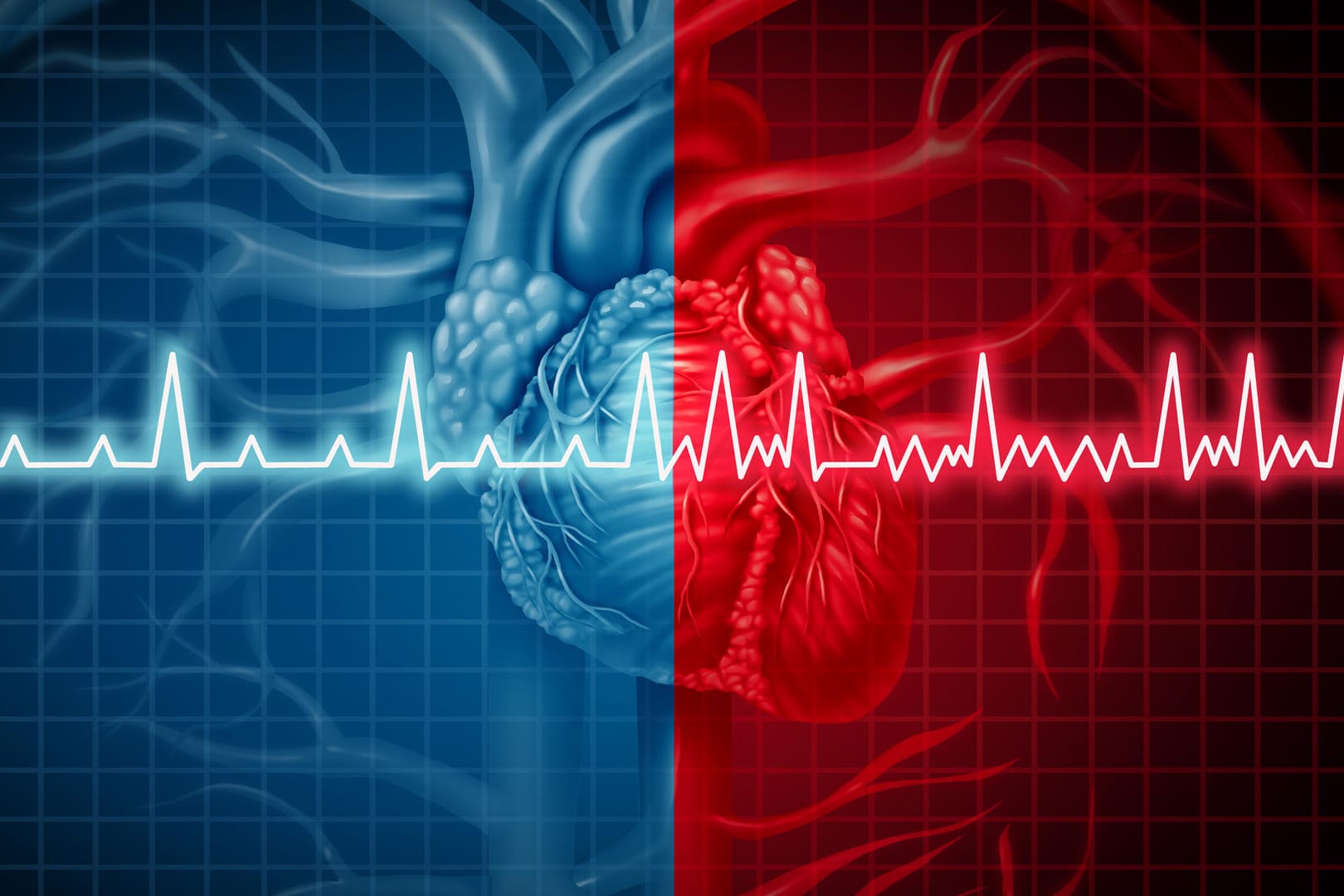 Herzrhythmusstörungen im EKG: Vorhofflimmern kann ein Blutgerinnsel auslösen und zu einem Schlaganfall führen.