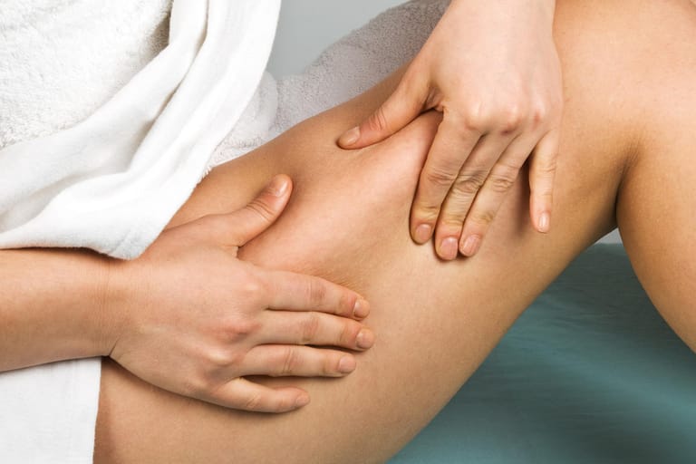 Eine Frau drückt mit den Händen die Haut ihres Oberschenkels. Beim sogenannten "Kneiftest" lässt sich Cellulite im Frühstadium erkennen.