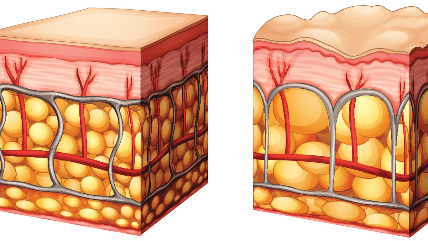 Grafische Darstellung gesunder Haut (links) im Vergleich zu Haut mit Cellulite. Deutlich erkennbar sind hier die vergrößerten Fettzellen, die für Wölbungen der Hautoberfläche sorgen.
