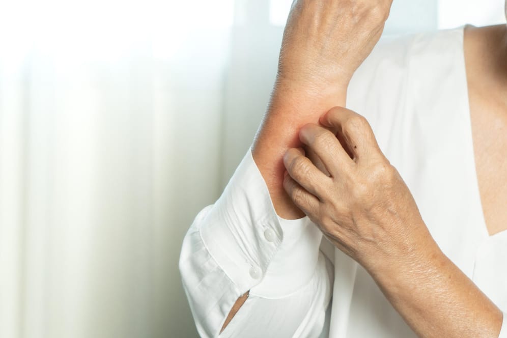 Eine Frau kratzt sich am Arm: Eine Nesselsucht geht meist mit starkem Juckreiz einher.