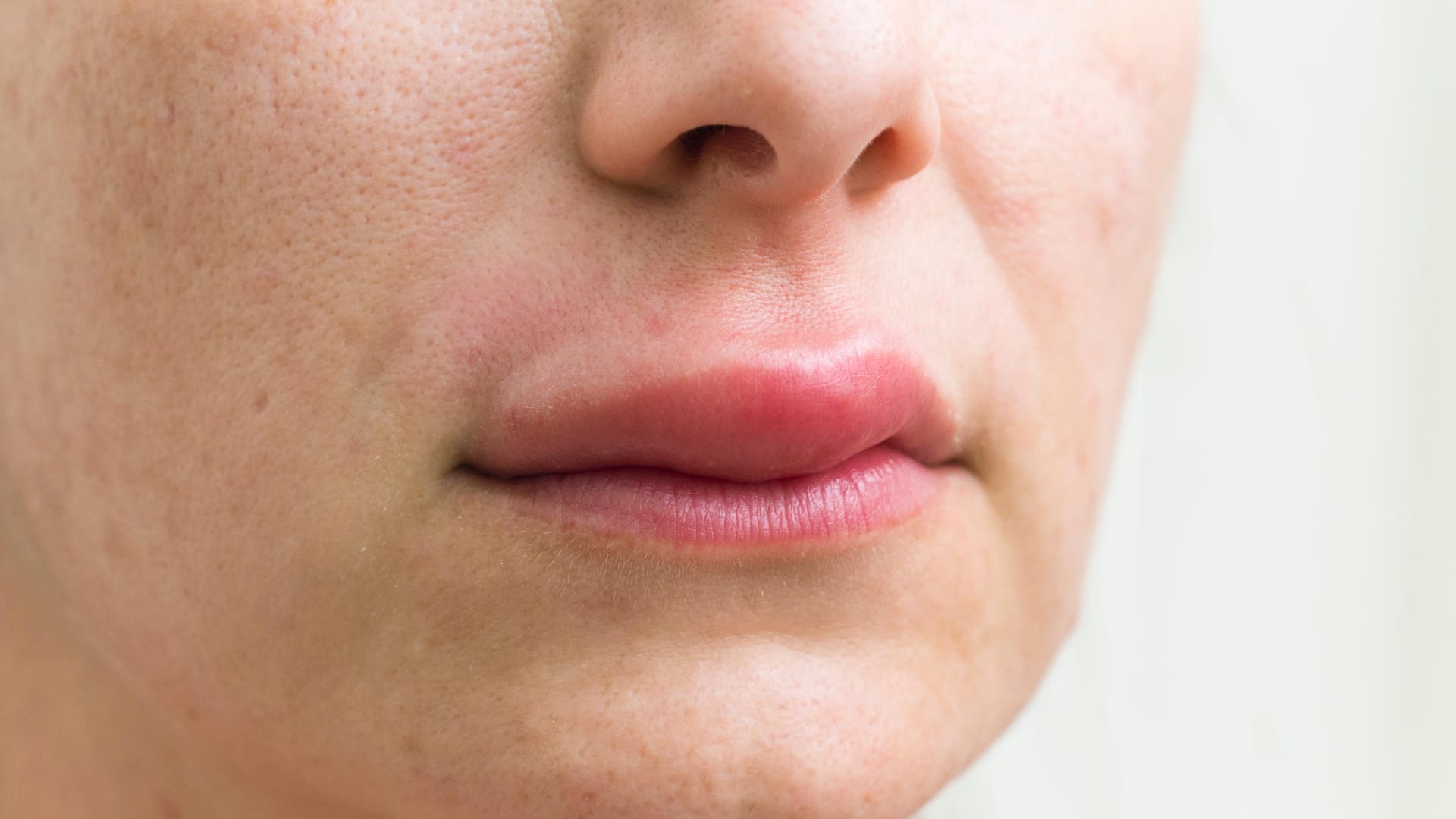 Angeschwollene Lippe: Das Angioödem kann Symptom einer Nesselsucht sein.