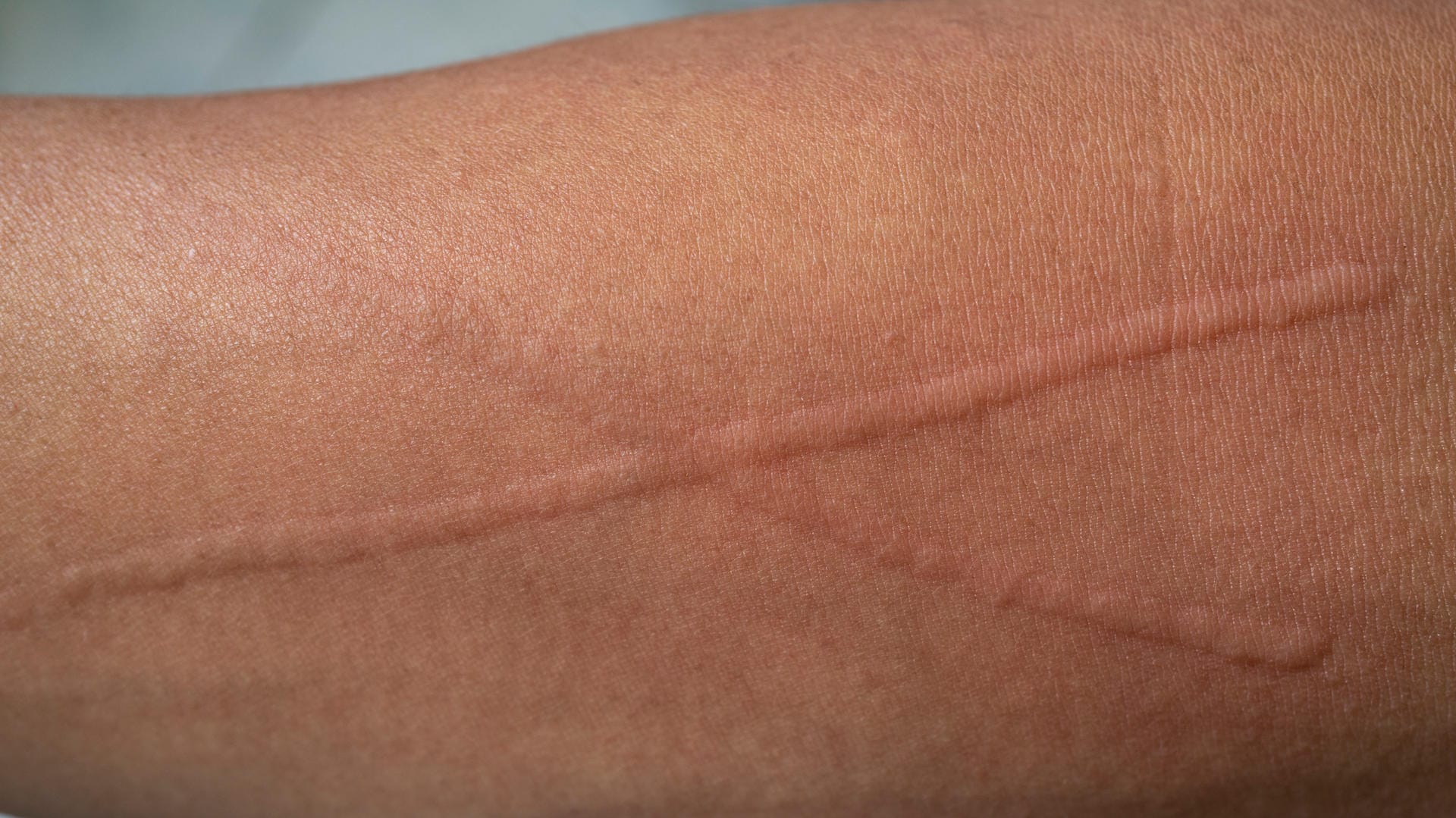 Urticaria factitia: Die Quaddeln bilden sich dort, wo Krafteinwirkung auf die Haut stattgefunden hat.