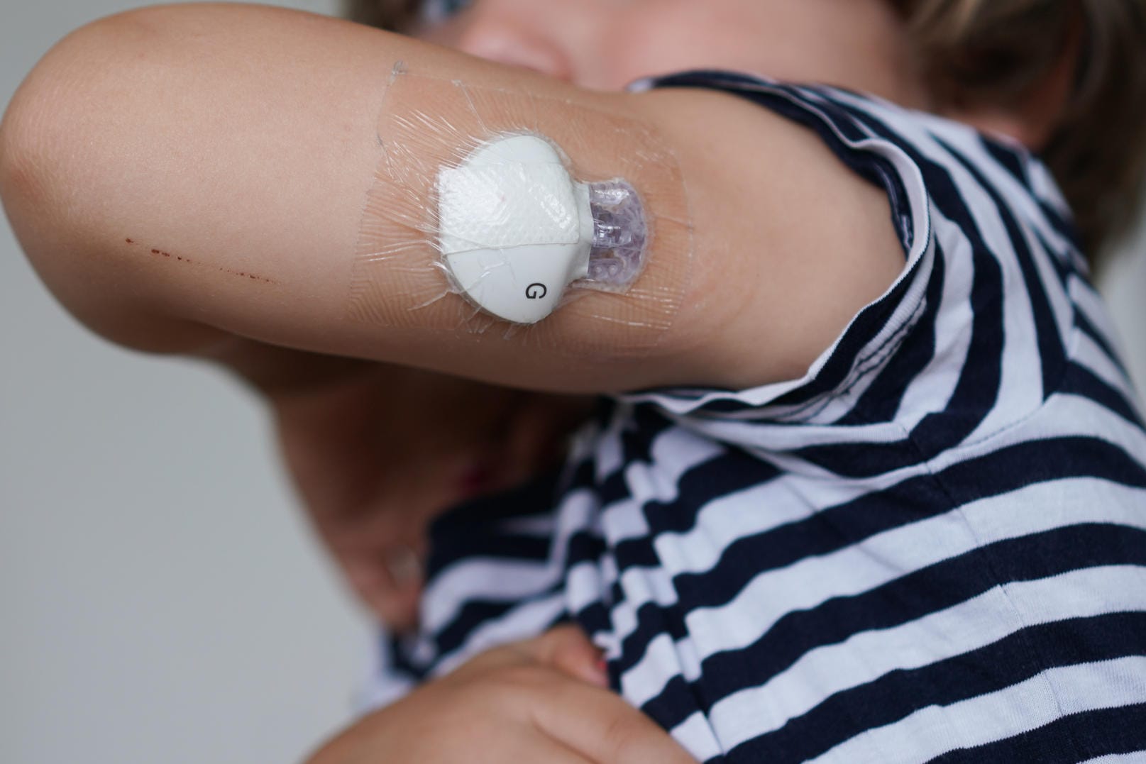 Diabetes bei Kindern: Auch gesunde und aktive Kinder können erkranken.