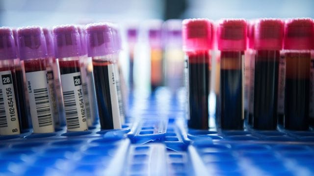 Spezielle Tests: Sie können Erbgut von Krebszellen im Blut nachweisen.