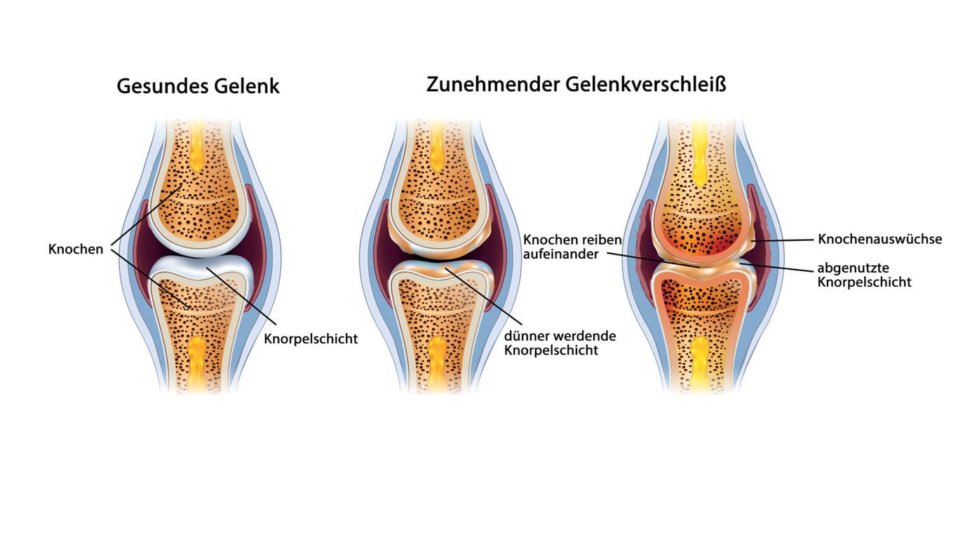 Gelenkverschleiß bei Arthrose: Über die Jahre wird die Knorpelschicht in Gelenken dünner.