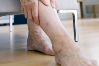 Geschwollene Beine und Füße (Symbolfoto): Manchmal können auch gefährliche Krankheiten dahinter stecken.
